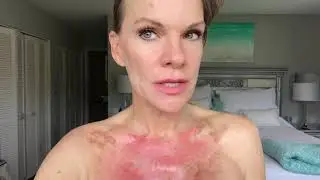 TCA 35% peel