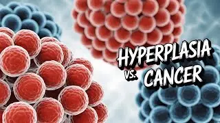 #Hyperplasia vs. Cancer: What's the Difference?
