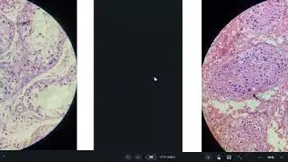 coagulative necrosis