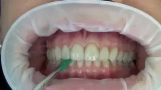 Checking the occlusal contacts with 8 microns paper