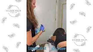 Lipodissolve (aka non-surgical fat melting)