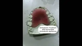 Orthodontic Treatment With Removable Orthodontic appliances Britanna Dental Clinic kandy