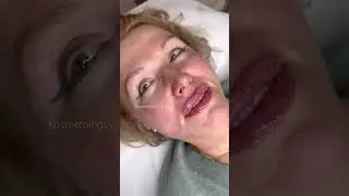 Natural lips💋 никаких пельменей❌ увеличение губ филлером🤩