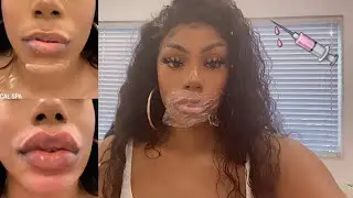 i got lip fillers | what did I do???