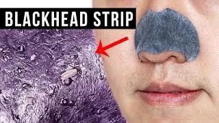 Blackhead Strip under a Microscope
