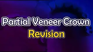 crown|partial veneer crown revision