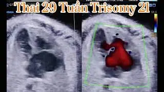 Si&ecirc;u &acirc;m thai 19w trisomy 21