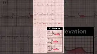 Acute Inferior STEMI ECG: ST-segment elevation in leads II, III and aVF