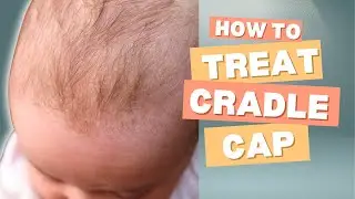 Cradle Cap Won't Go Away? Here's What Actually Works | NP Explains