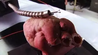 A robotic snake is being used for heart surgery.