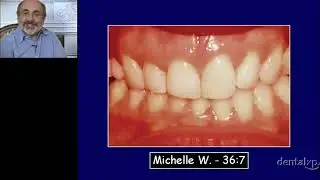 Management of Tooth Wear in the Adult Patient  - Part 1