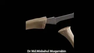 MCP Joint Surface Arthroplasty (Silicone)