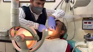 Extraction -17 Full Procedure#extraction #dental #hairtransform #drrohitsinghbhopal