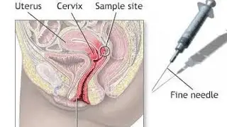 Boggy swelling in the cul de sac; abnormal fluid accumulation in pouch of Douglas
