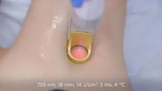 excel HR Laser - Hair Removal treatment video