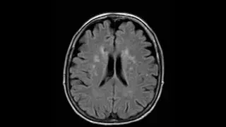 Does Migraine Cause MRI Abnormalities