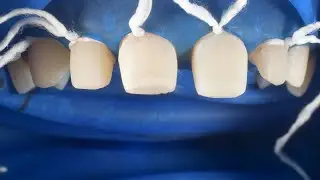 Ceramic Veneer Cementation | Porcelain Laminates Bonding | Adhesive Cementation