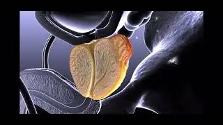 Prostate cancer animation