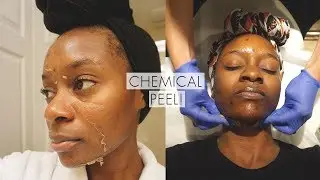CHEMICAL PEEL FULL PROCESS! | Remove Dark Marks Acne Scars and Acne with Chemical Peel