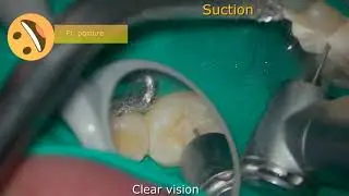 Suction position and patient posture-#46 mandibular molar mirror work