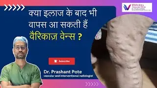 Varicose Veins Truth About Permanent Removal | Dr. Prashant Pote