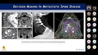 Decision Making in Metastatic Spine Disease : Benjamin Kafka May 9, 2022