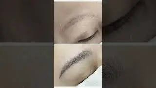 InstaBrow Eyebrow Transplant | Natural, Permanent Brows at RJ Clinic ✨