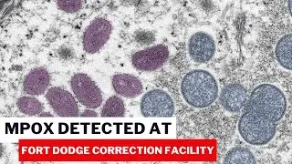 🚨 Mpox detected at Fort Dodge Correctional Facility - How Safe Are You?