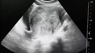 Bulky uterus with fibroid#ultrasound #sonography #shortsvideo #usg3d #