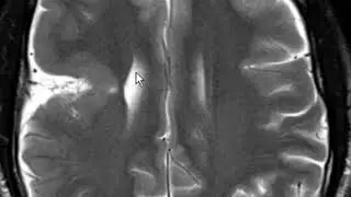 Polymicrogyria