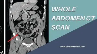 CT W/A Scan- Step by Step Process Explained.CECT W/A Test-Everything You Need to Know | MSKVLOGS786&rdquo;