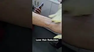 Laser Hair Reduction #laserhairremoval #viral #shorts