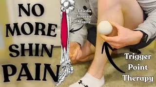 I Got Rid Of My Shin Splints (SIMPLE 3 Step Process)