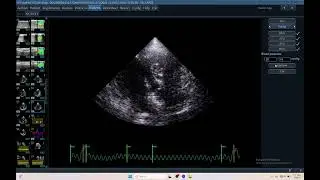 IQ 694 RV GWE MYOCARDIAL WORK EFFICIENCY RVEF RVGLS RVPSD RVTTP ECHOCARDIOGRAPHY
