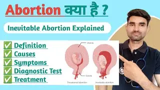 Inevitable Abortion in Hindi | Causes, Symptoms And Treatment of Inevitable Abortion