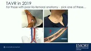 CVI 2019_Friday 7/19_ Innovations in Structural Heart Therapy_Adam Greenbaum, MD