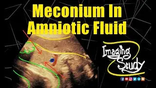 Meconium in Amniotic Fluid || Ultrasound || Case 314