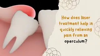 How does laser treatment help in quickly relieving pain from an operculum?