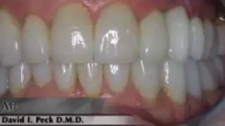 Cosmetic Dentistry in Springfield  Laser Gum Contouring for Gummy Smiles