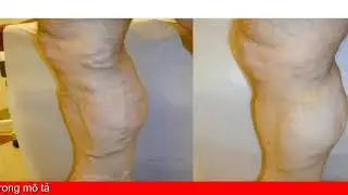 Kem Varikosette Điều Trị Gi&atilde;n Tĩnh Mạch
