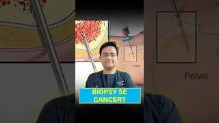 Kya Biopsy Se Cancer Failta Hai?