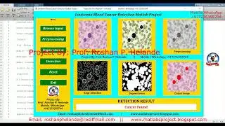 Leukemia Blood Cancer Detection Using Image Processing | Leukemia Detection Using Machine Learning