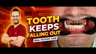 Tooth Kept Falling Out After Implants | Full Mouth Fix in Istanbul