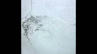 Prostate artery embolization(PAE)  by irdocnigeria