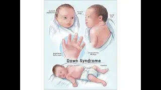Down Syndrome | Autosomal Trisomies | USMLE step 1 | Lecture 11