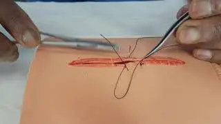 Mattress and pulley sutures