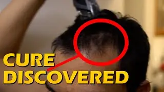 How To STOP HAIR LOSS FOREVER. PERMANENT SOLUTION FOR HAIR LOSS