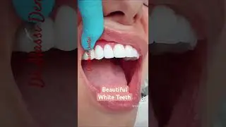 Beautiful Smile Makeover