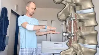 Spondylolistéza po operácii