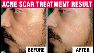 Best acne scar treatment | Sakhiya Skin Clinic Patient Review